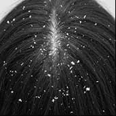 Dandruff